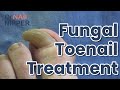 What is fungal toenail? Fungal Toenail Treatment - FEET-ure Friday (2021)