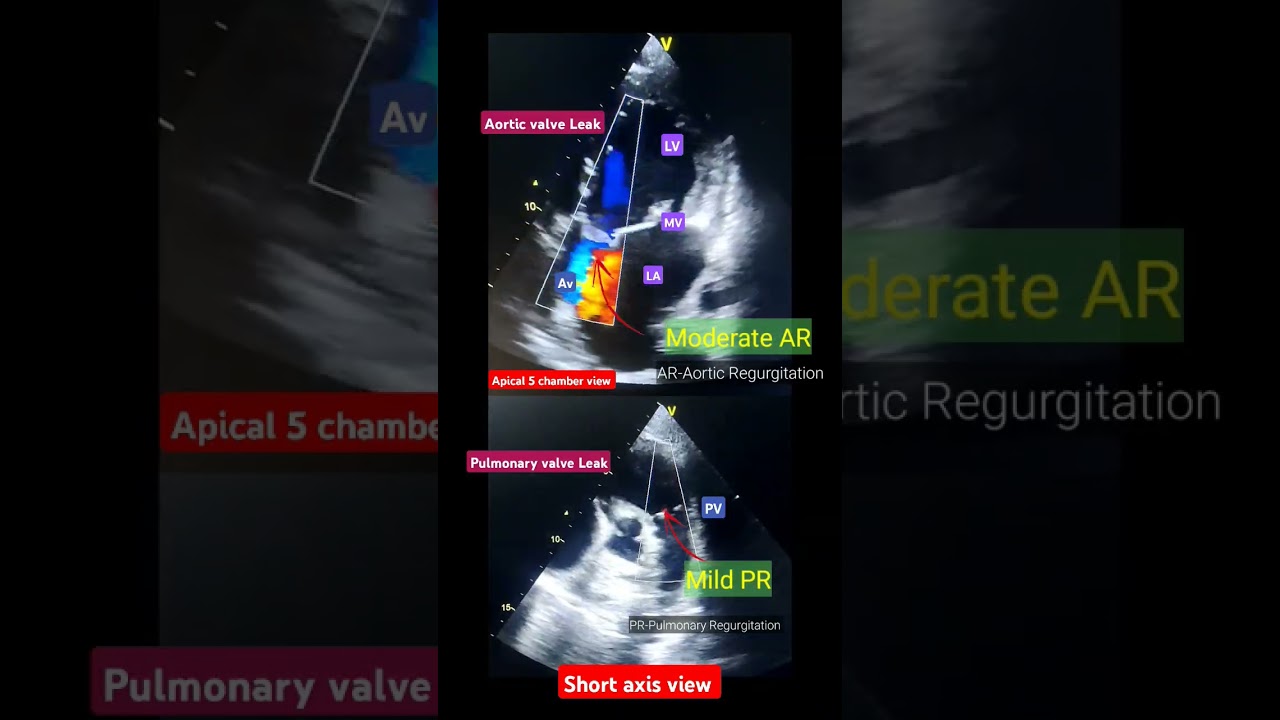 AR/ PR ( Valve Leak) Echo l वाल्व लीक इको 