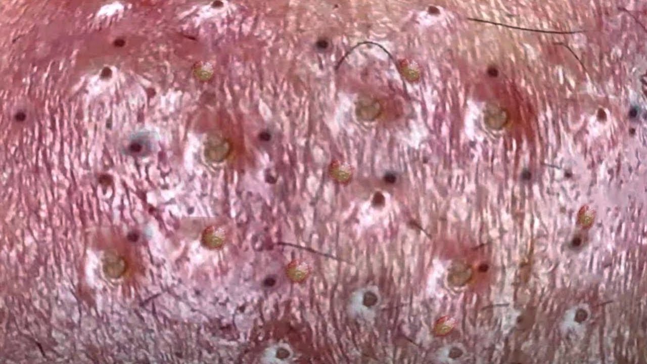 Squeeze blackheads Acne And Pimples Make your Acne Treatmen Never