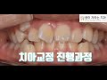 20초로 보는 치아교정 / braces before and after orthodontics timelapse