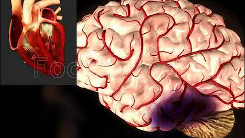 Atrial Fibrillation and Stroke - Animated Atlas of Atrial Fibrillation