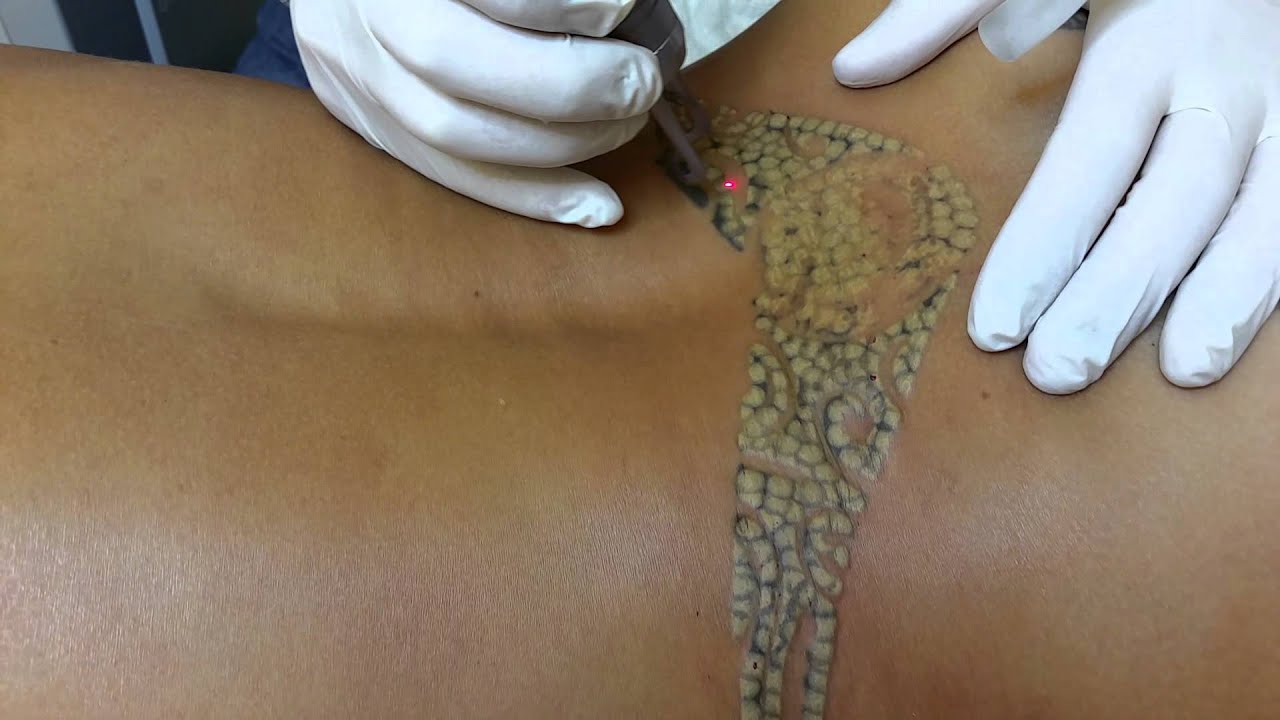 Tattooentfernung mit Laser von V-Skin - YouTube
