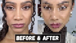 SEE THE LATEST RESULTS, 3 Months after my Rhinoplasty (Part 4) Tiana Peri