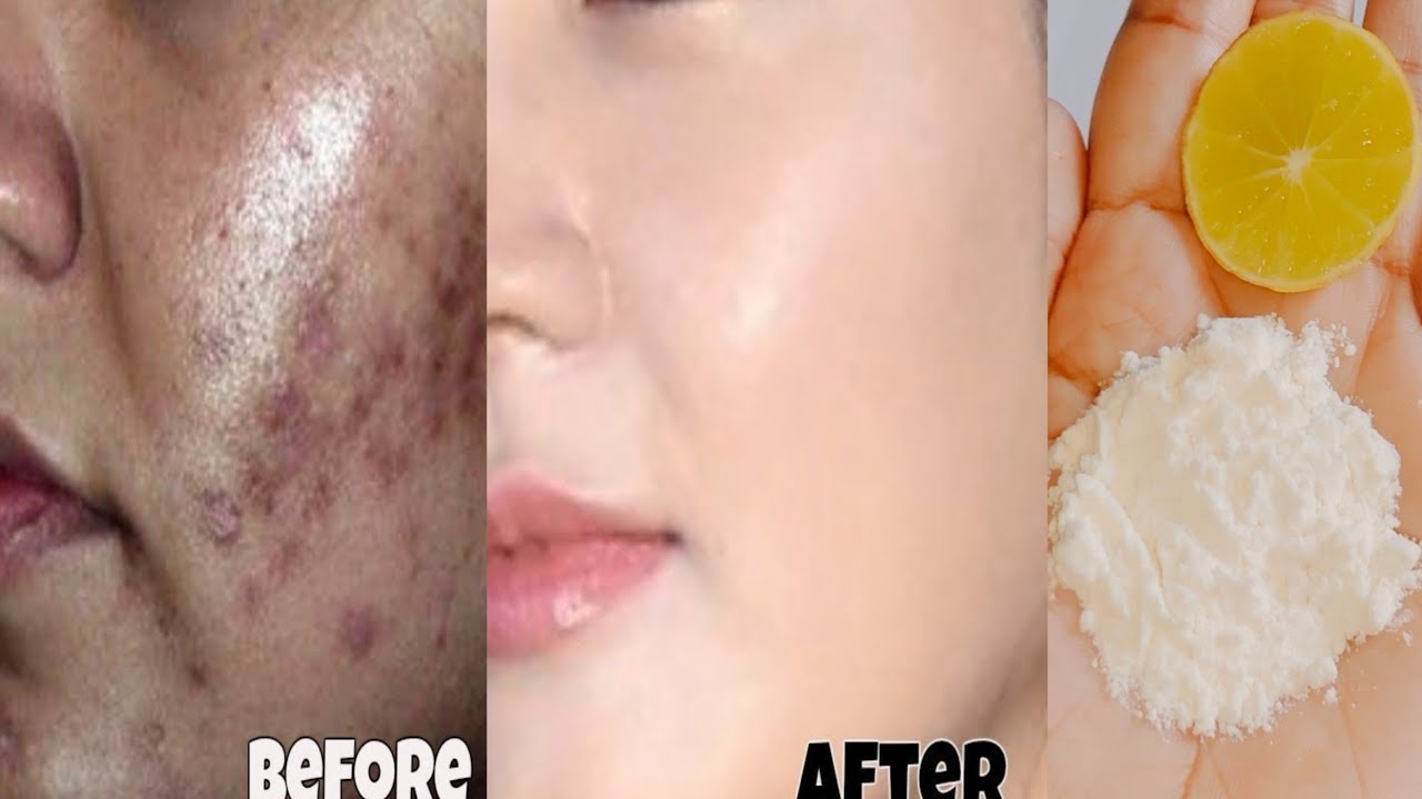 How to remove dark spots,pigmentation, acne in 5 minutes How to treat dark spots on face YouTube