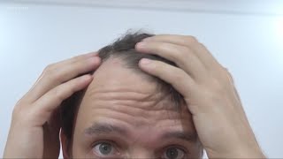 Stress can cause hair loss: Here