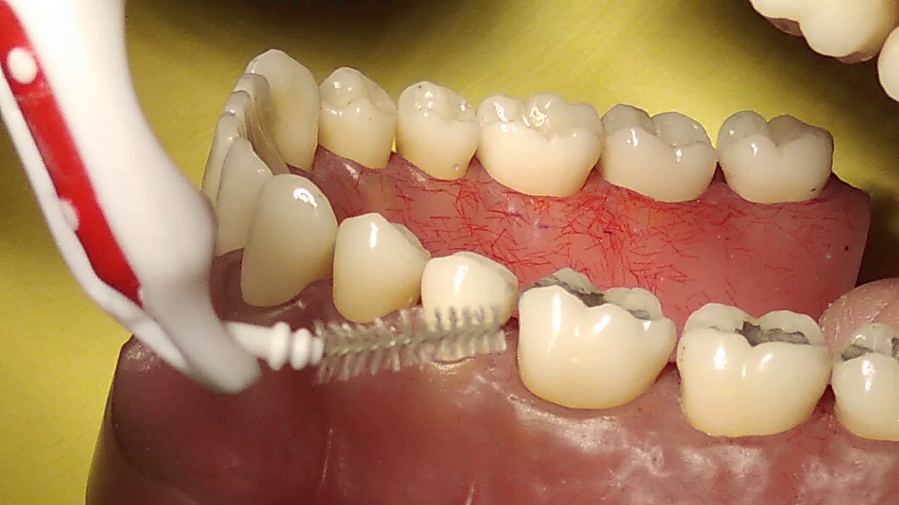 Prévention des gingivites : brossette et fil dentaire au coude à