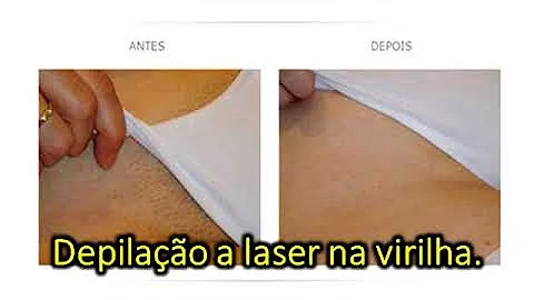 Como é a depilação a laser virilha completa?