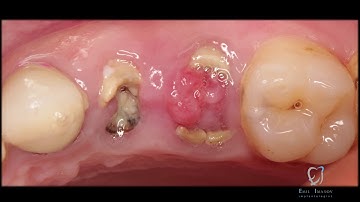 Socket Preservation (Socket Shield Technique ) For Dentists (IMPLANTOLOGIST  Dr. EMIL IMANOV)