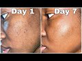 One Week of APPLE CIDER VINEGAR on my Face to Get Rid of Dark Spots & Acne Scars *SHOCKING RESULTS*