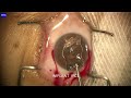 Implant phaque ipcl chirurgie intraoculaire par addition dune lentille par dr trinh paris