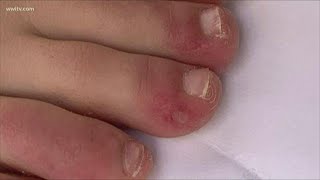 Skin rashes identified as possible COVID-19 symptoms