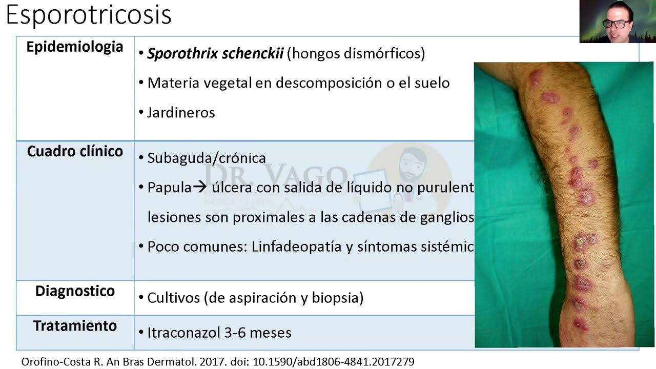 esporotricosis-en-jardineros-enarm-youtube