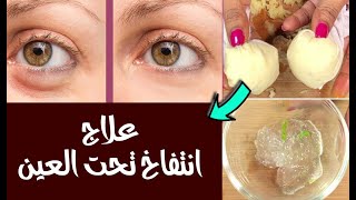 علاج الانتفاخ تحت العيون: 8 وصفات مجربة ستحل المشكلة نهائياً للنساء والرجال