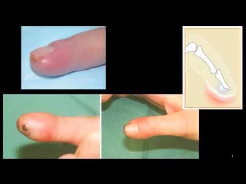 Ortho Dx: A Persistent Finger Infection in a 61-Year-Old Female - Clinical  Advisor