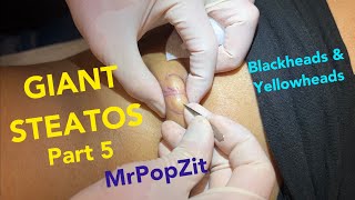 Giant Steatocystomas part 5. Butter bumps, blackheads, and the rarely seen yellowhead extractions