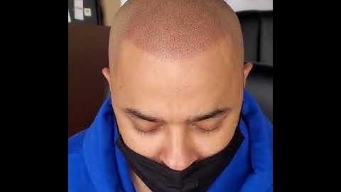 Scalp Micropigmentation
