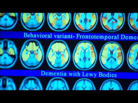 Video: Ciri-ciri Neuroimaging Demensia Dengan Badan Lewy