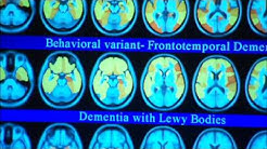 Imaging Dementia-Mayo Clinic