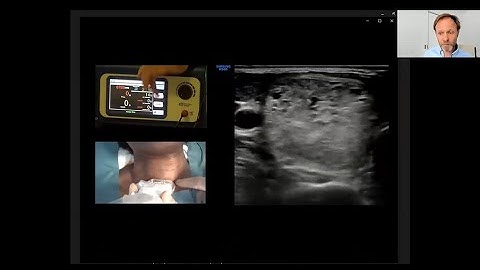 THYBLATE™ Thyroid RFA Webinar