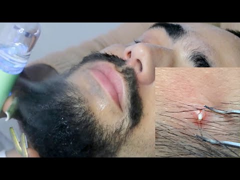 ASMR | Face Picking, Checking & Steaming 🤯.