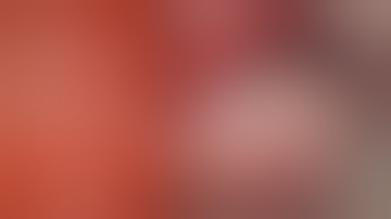 Vertical augmentation with Customized Titanium Mesh - [Dr. Kim Yongjin]