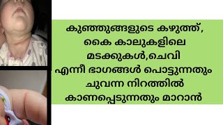 How To Treat And Care Neck And Skin Fold Rashes In Babies | Baby care Malayalam screenshot 2