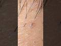 #plucking #satisfying #tweezers #blackheads #pimple #skincare #hairremoval #hair #ingrownhair #毛抜き