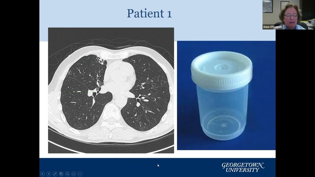 Update on Bronchiectasis Treatments Including new Investigational