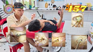 Professional Earwax Removal. Episode 157.