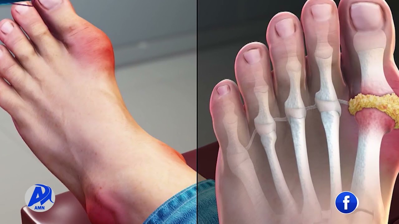 የሪህ በሽታ መንስኤ፣ ምልክቶችና መከላከያ መንገዶች.../አዲስ ሚዲያ ኔትወርክ ታህሳስ 5/2014 ዓ.ም