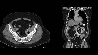 Large bowel lymphoma