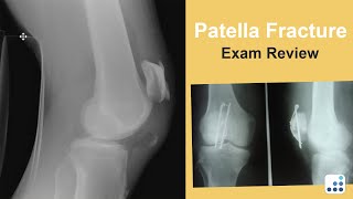 Patella Fracture Exam Review - C. Lowry Barnes, MD