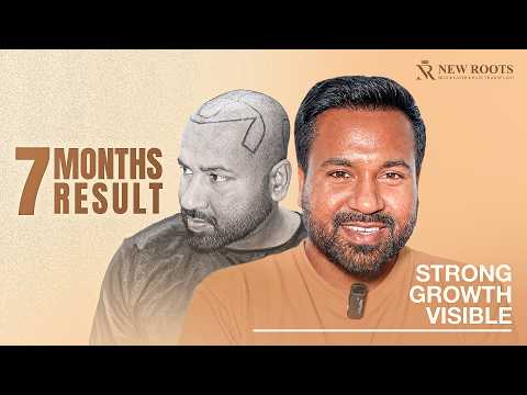 My 3rd PRP Session & Hair Growth Looks Promising 🔥 | Hair Transplant in Raipur | New Roots