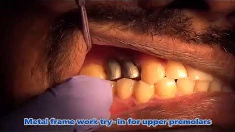 Metal framework try   in for upper premolars with basal implants