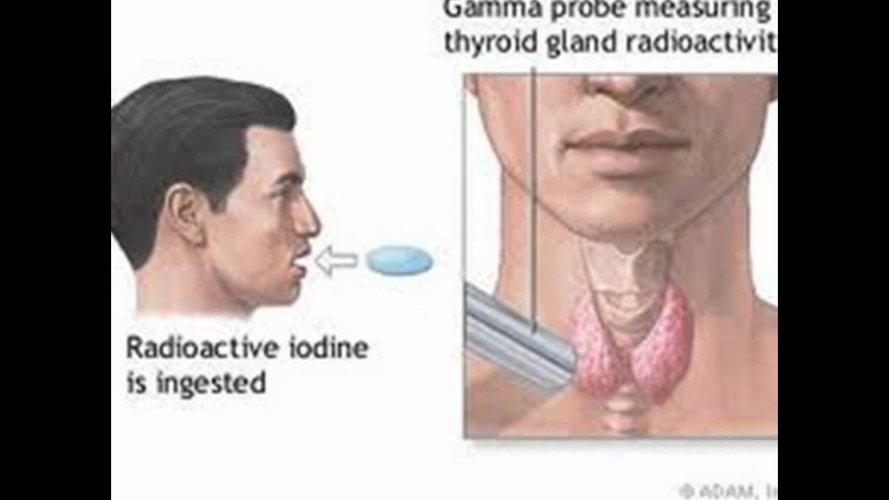 Радиоактивный йод щитовидная