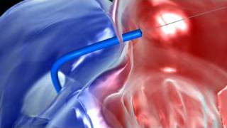 NHS PFO Device