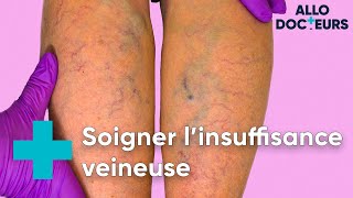 Jambes Lourdes Varices Il Existe Des Solutions - Allo Docteurs