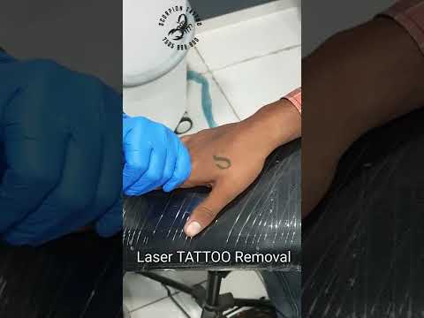 Laser TATTOO removal
