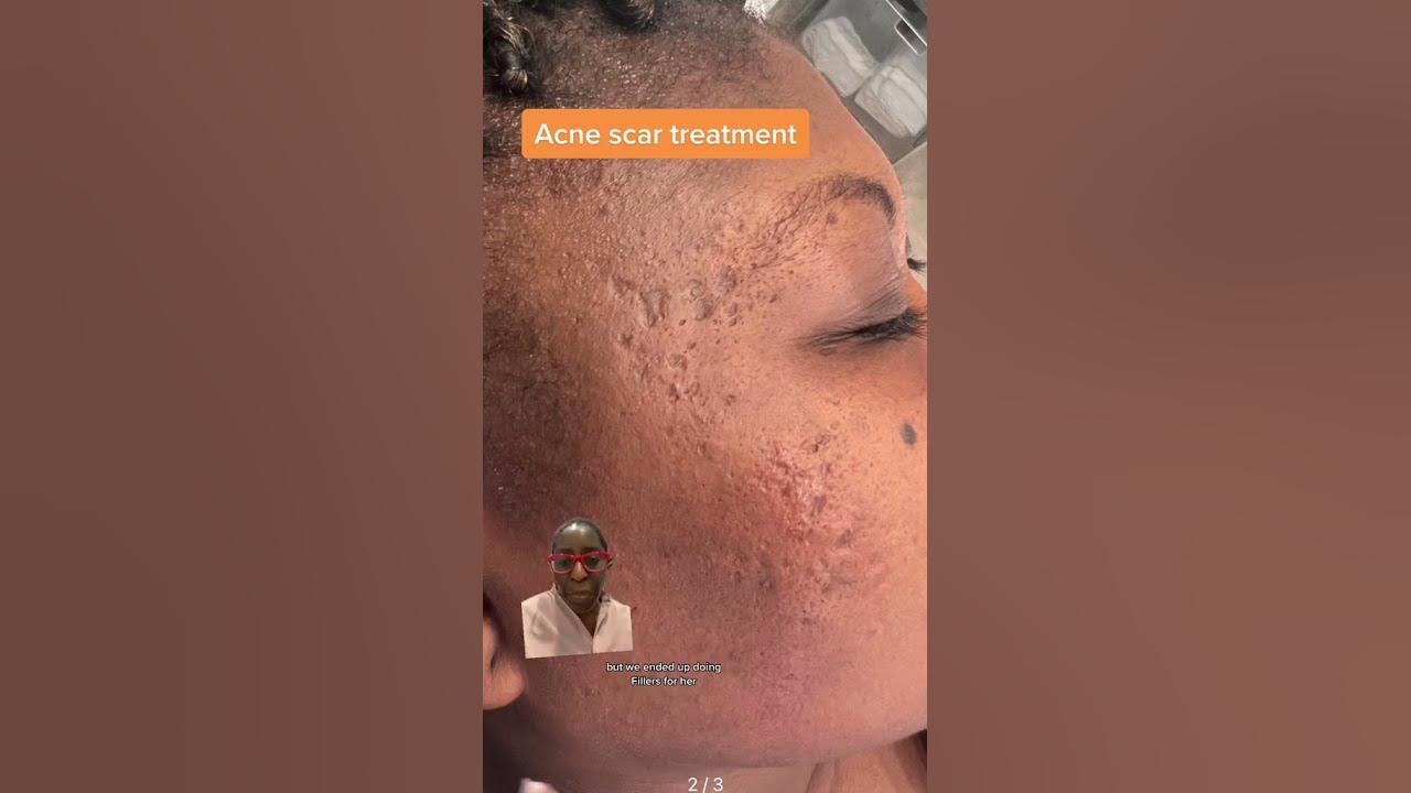Atrophic scar treatment with dermal fillers blackskincare youtube