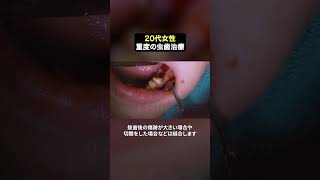 1日で重度虫歯もここまで綺麗に‼️#ザホワイトデンタルクリニック  #歯医者  #虫歯 #重度虫歯