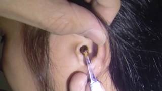 Top 5 Women with Massive Earwax Removal