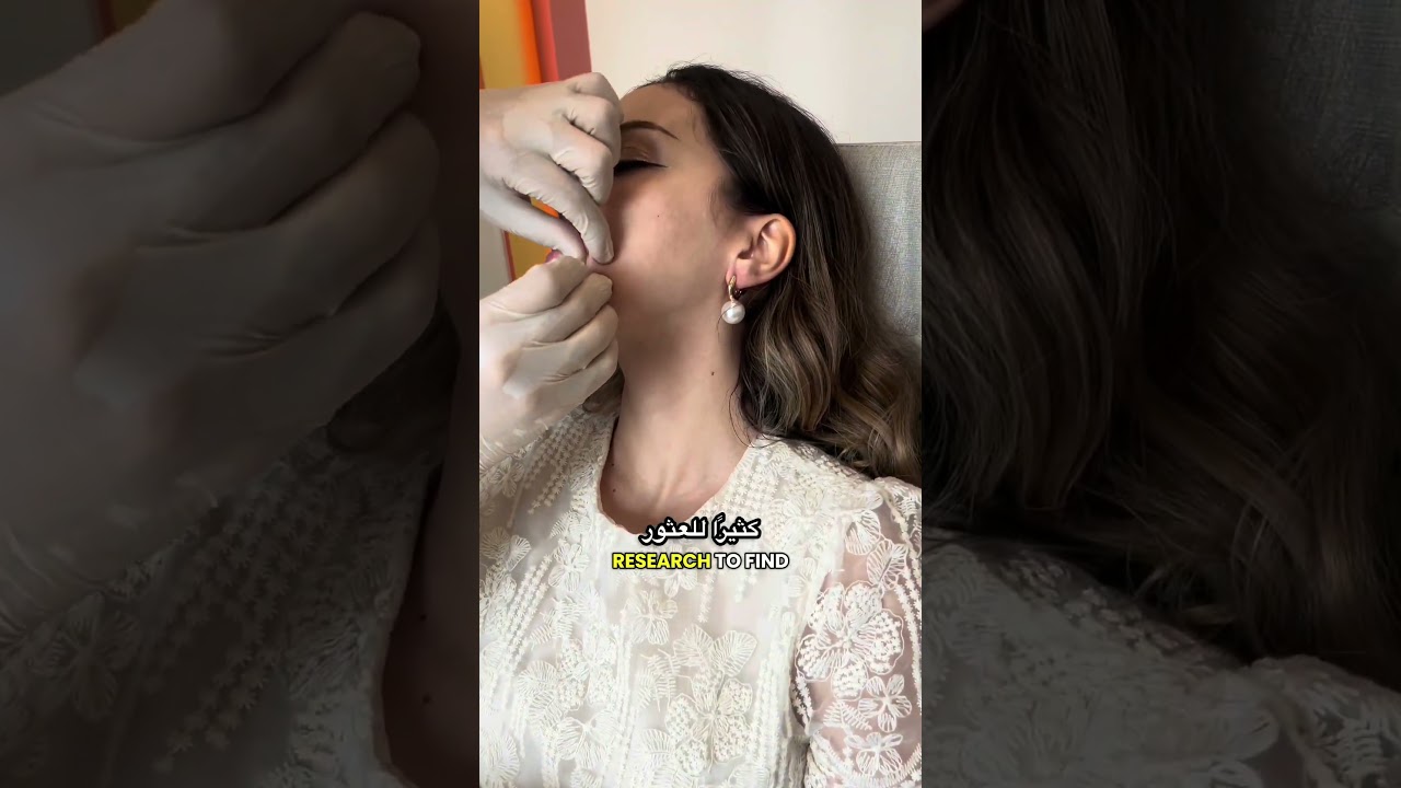 [뷰티블라썸의원] deeps smile lines #skincare#smile#wrinkels#glassskin#glowup#hongdae#korea#seoul#skin#doctor#derma#