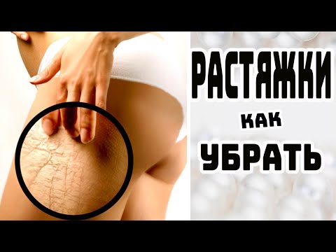 КАК УБРАТЬ РАСТЯЖКИ НА ТЕЛЕ / УДАЛЕНИЕ РАСТЯЖЕК / СОВЕТЫ КОСМЕТОЛОГА