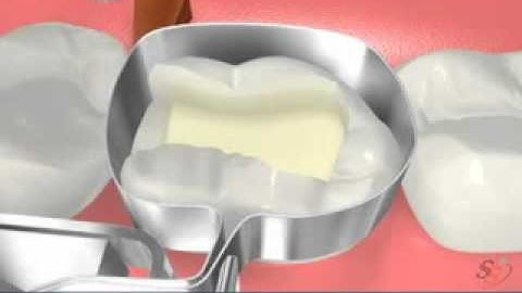 Class II Amalgam .FLV