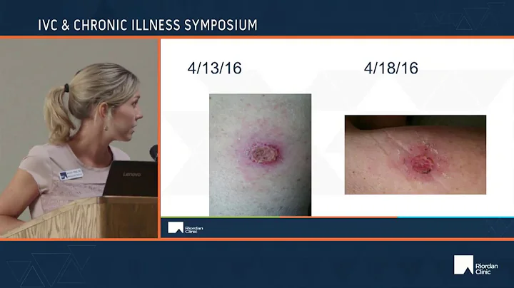 Vitamin C and Melanoma- Jennifer Mead, ND