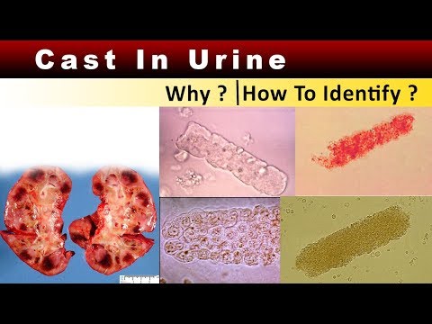 Cast in Urine  ( Why & How to Identify ? )