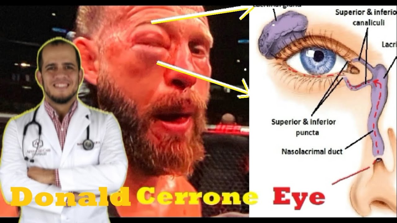 Cowboy Cerrone Swollen Eye explanation. YouTube