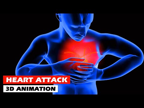 Heart Attack |