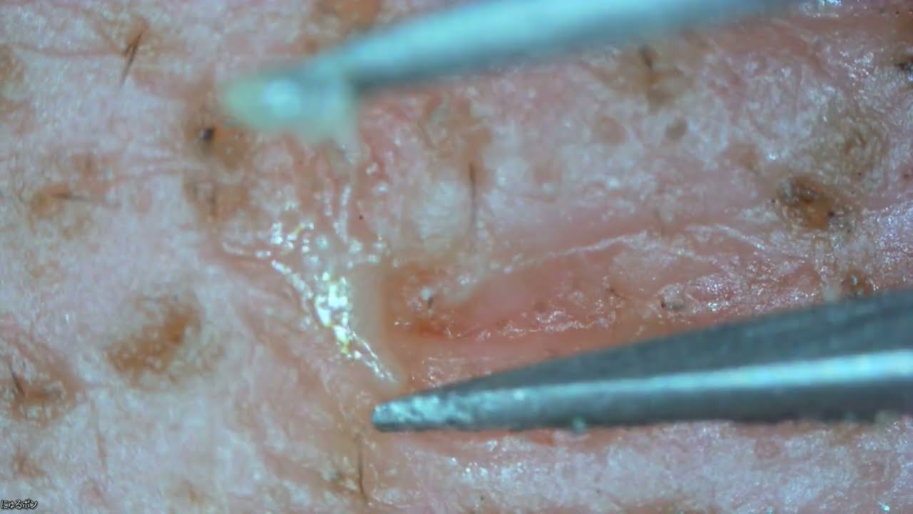 0040 keratin plug removal amount 角栓抜き 額 YouTube