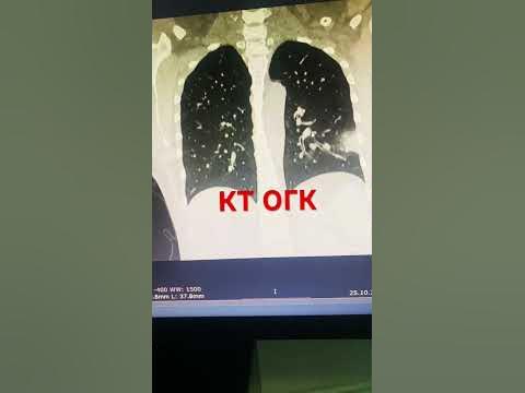 Рентген ОГК или КТ ОГК - YouTube